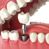 Zahnarzt Dr. Piehslinger 3D navigierte Zahnimplantate mit CEREC Schiene und Cerec Krone